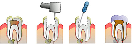 Tratamente endodontice